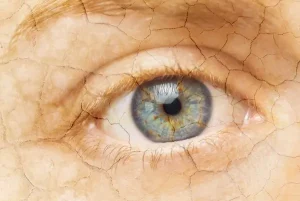 Dry Eyes- Causes, Symptoms, and Treatment