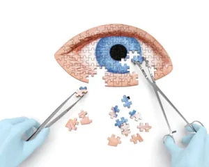 Surgery for eye Color Change