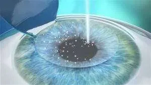 FemtoLASIK- Excimer laser correction