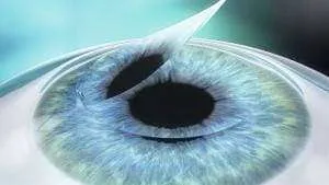 Femtolasik flap lifting