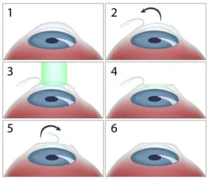 LASIK-OP steps