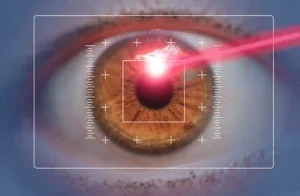 Laser eye surgery for presbyopia
