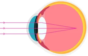 Myopie. The object is focused before the retina