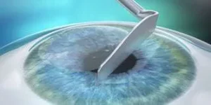 PRK epithelium removal