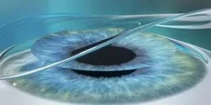PRK_- After excimar laser Contact lens fitting
