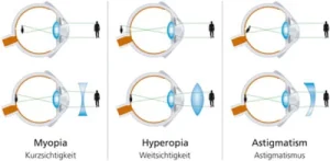 Refractive errors