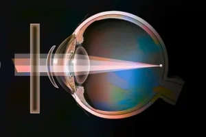 Treatment option of astigmatism