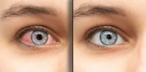 Dry eyes