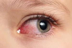 Irritant Conjunctivitis
