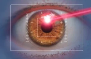 Illustration of laser treatment of the cornea during laser eye surgery